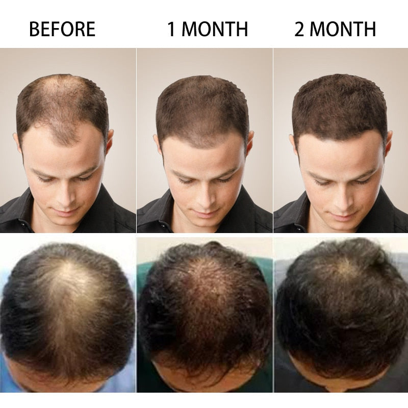 2023 Biotin Fast Hair Growth Oil Hair Regrowth Serum Hair Thinning Treatment Hair Growth Liquid Anti-Hair Loss for Women & Men - adorables